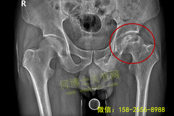 治疗股骨头坏死