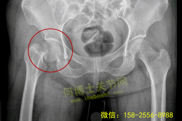 颈腰椎诊疗康复案例