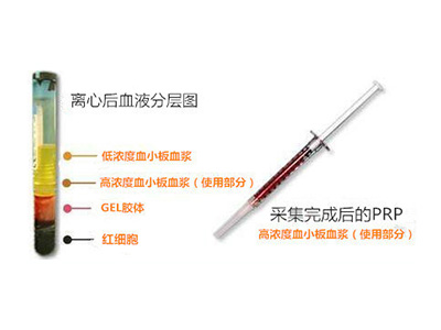 PRP细胞再生因子治疗关节损伤和老化