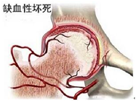 股骨头坏死