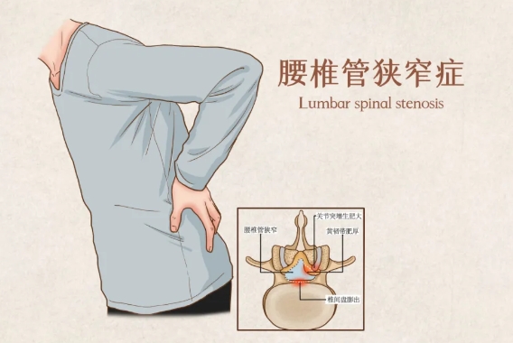 战胜椎间孔狭窄，重塑脊椎健康！