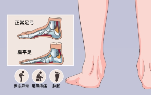 2-6岁家长请注意！别让扁平足影响孩子运动能力！