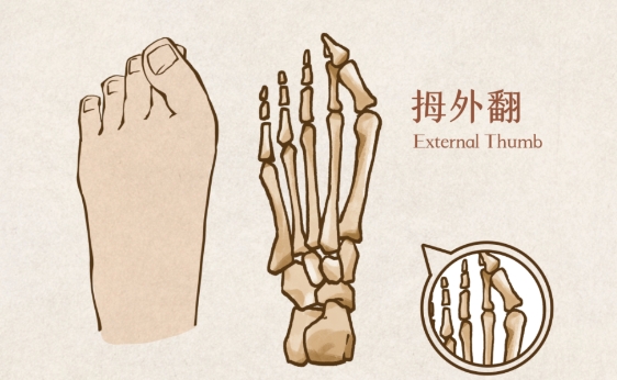 长期穿高跟鞋，当心“踇外翻”