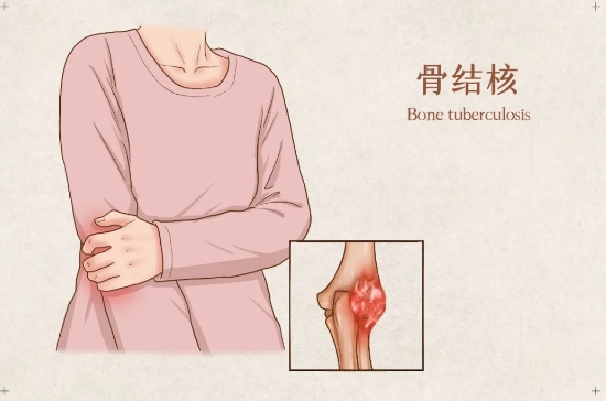 一次读懂骨结核，让你远离病痛！