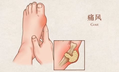 痛风来袭？揭秘如何打赢这场“痛”战！