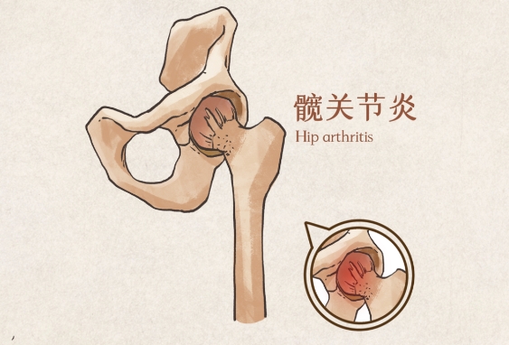 髋关节炎不只是老年病，年轻人也要注意！