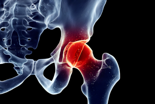 半髋置换 vs 全髋置换：骨科医生教你如何“押对宝”。