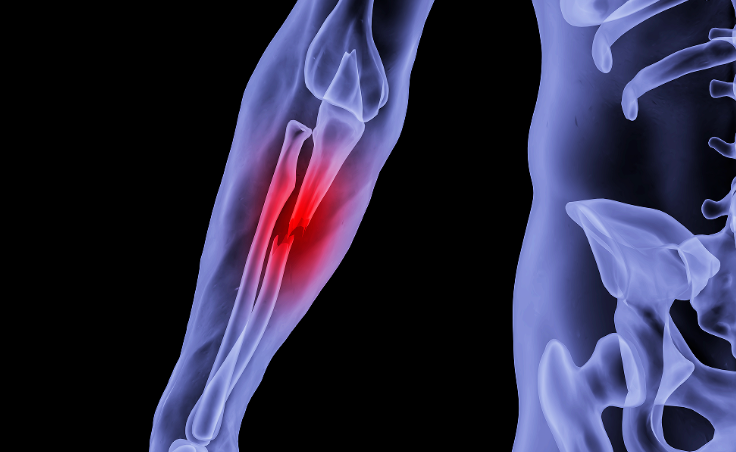 体内的“钢板钢钉”，是取出来好，还是一直留着好？